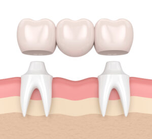 ponte-dentale