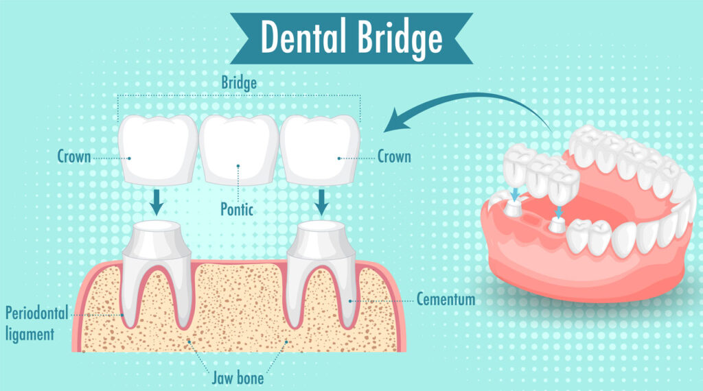 Ponte dentale, cos’è e a cosa serve